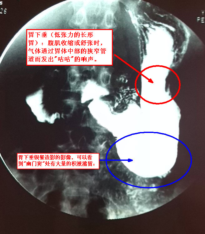 胃下垂(低张力的长形胃)：腹肌收缩或舒张时，气体通过胃体中部的狭窄管道而发出“咕咕”的响声。.jpg