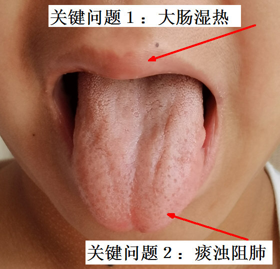 关键问题1：大肠湿热；关键问题2：痰浊阻肺.jpg