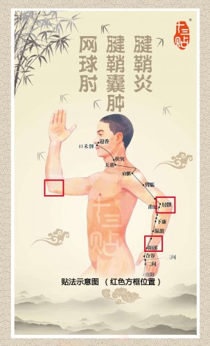 腱鞘炎 网球肘.jpg